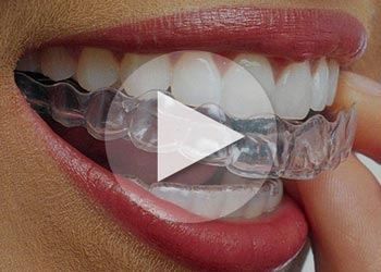 Grand Rapids Invisalign