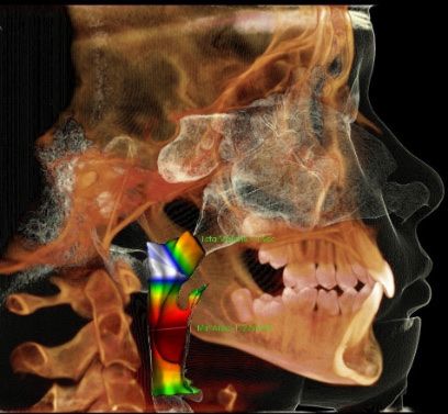3D CBCT scan showing airway volume analysis used in airway-focused orthodontic treatment in Grand Rapids, MI