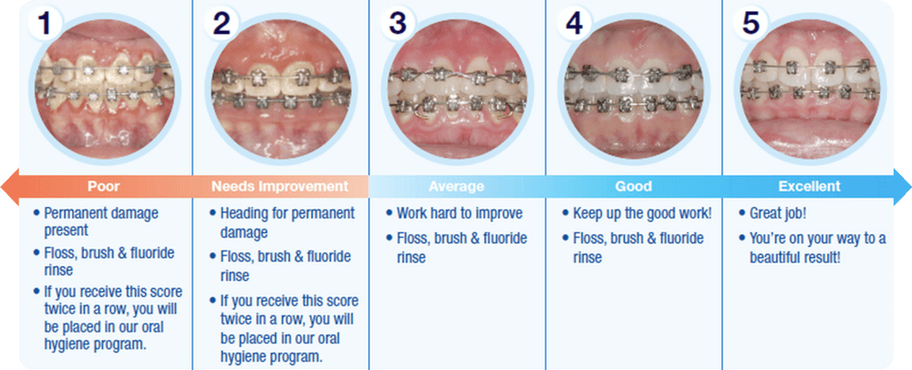 Braces Care Instructions Armbrecht And Wierenga Orthodontics 