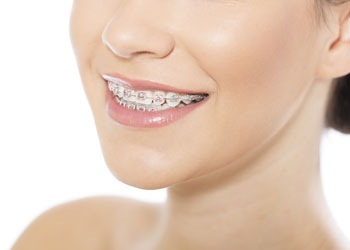 What Is an Overbite and How Can Braces Help?