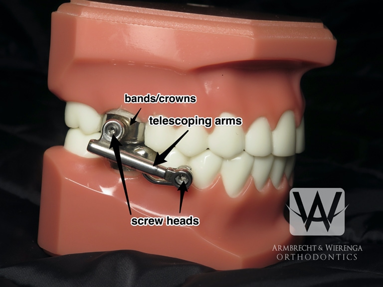 5 days in - how do I know when there's a wire poking versus normal metal  pokey annoyance? If I always keep wax on the molar brackets will my mouth  ever get