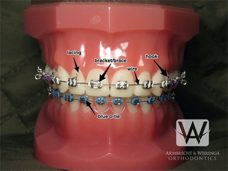 Braces Care Guide, Frequently Asked Questions About Braces