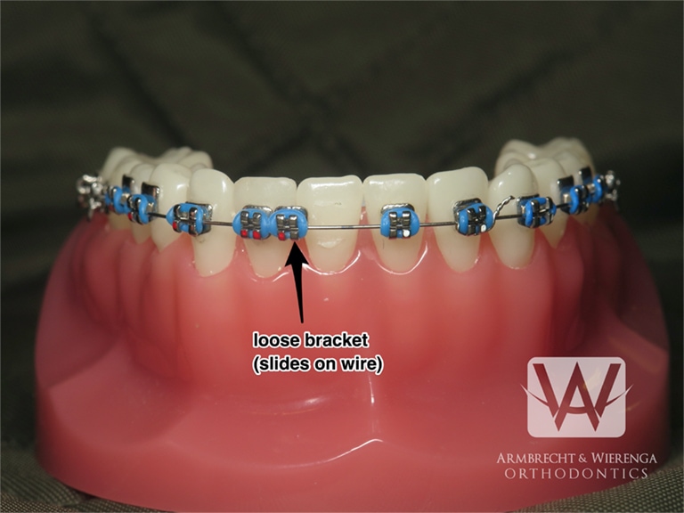 What to do when I have an orthodontic wire sticking out and poking the gums?