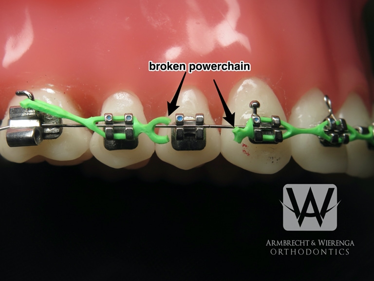 Broken Braces? What to do if a Bracket or Wire Breaks (Don't Panic!)