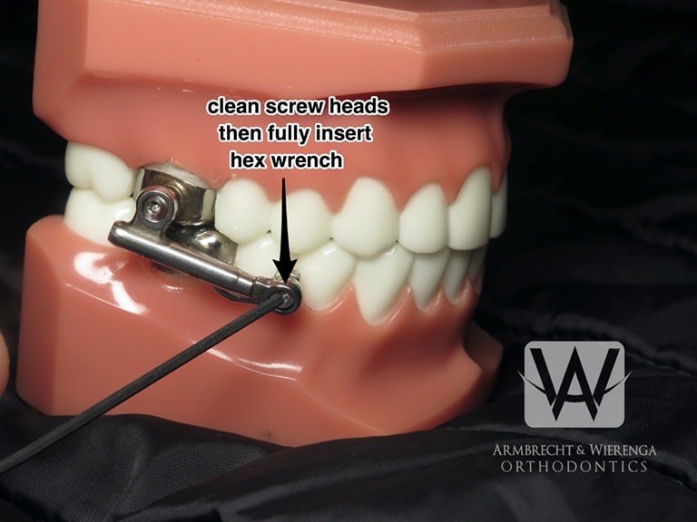 Braces Help Orthodontist in Grand Rapids