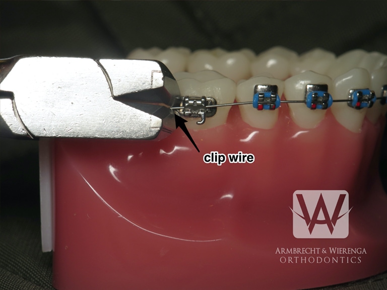 Braces Brackets Help Orthodontist in Grand Rapids