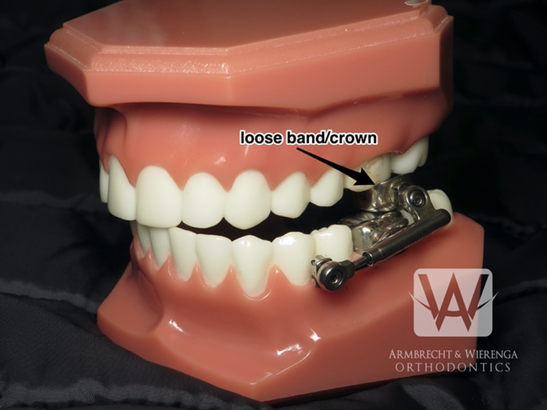 Braces Help Orthodontist in Grand Rapids