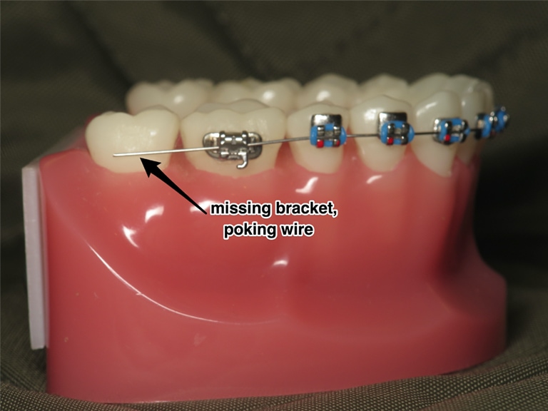 5 days in - how do I know when there's a wire poking versus normal metal  pokey annoyance? If I always keep wax on the molar brackets will my mouth  ever get