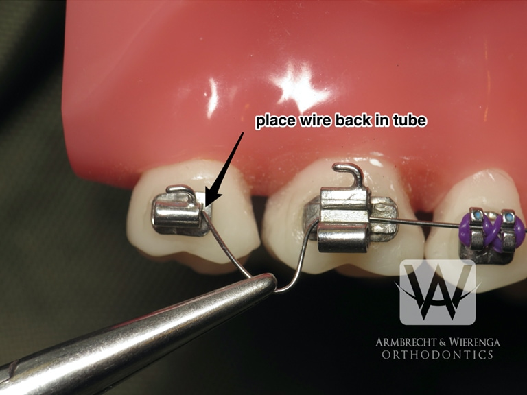 Braces Care Guide Frequently Asked Questions About Braces Grand