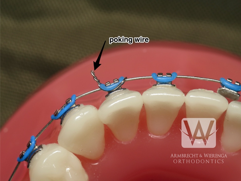 5 days in - how do I know when there's a wire poking versus normal metal  pokey annoyance? If I always keep wax on the molar brackets will my mouth  ever get