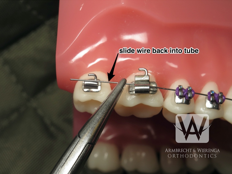 What to do when I have an orthodontic wire sticking out and poking the gums?