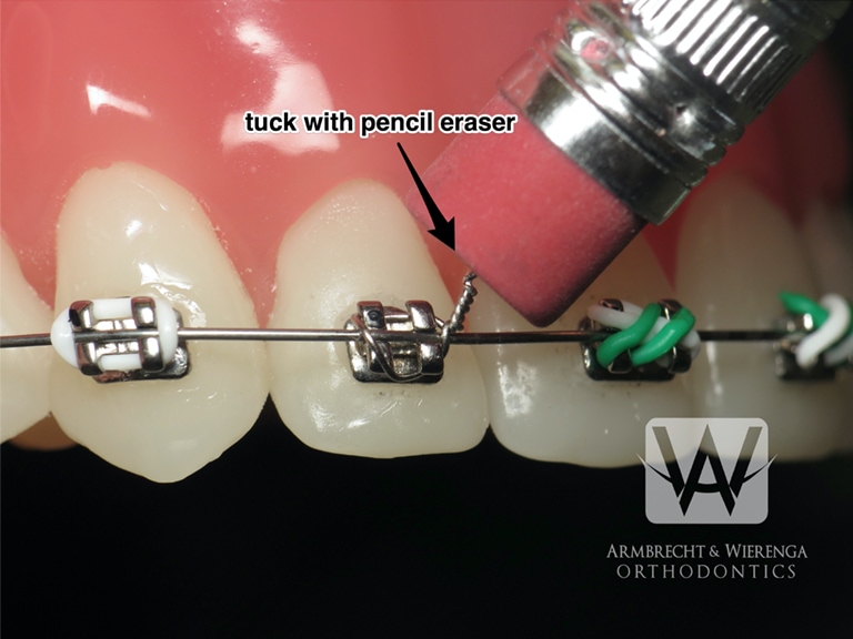 How to Handle Pokey Wires and Home and Other Orthodontic Tips - Belmar  Orthodontics
