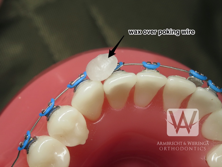 Braces Help Orthodontist in Grand Rapids