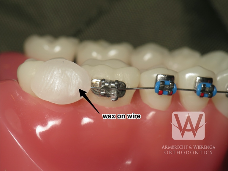 5 days in - how do I know when there's a wire poking versus normal metal  pokey annoyance? If I always keep wax on the molar brackets will my mouth  ever get