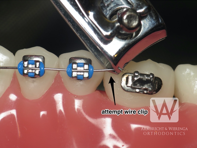 Braces Help Orthodontist in Grand Rapids