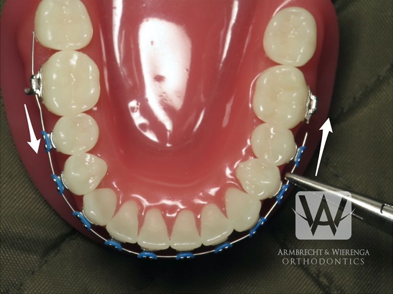 What to do when I have an orthodontic wire sticking out and poking the gums?