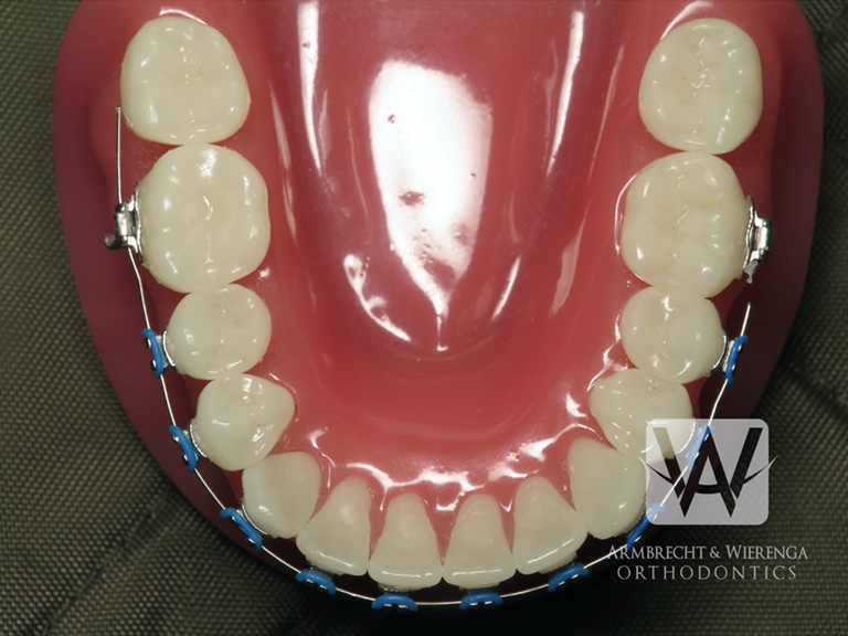 5 days in - how do I know when there's a wire poking versus normal metal  pokey annoyance? If I always keep wax on the molar brackets will my mouth  ever get