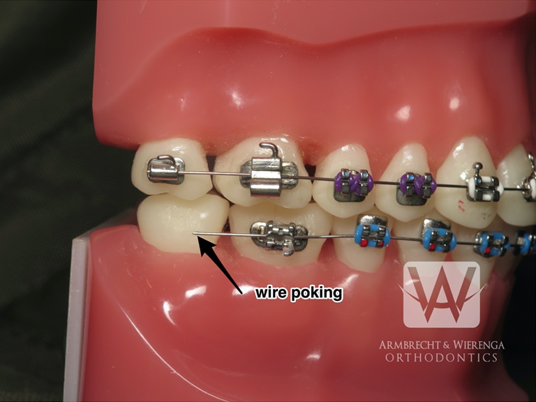 How to Handle Pokey Wires and Home and Other Orthodontic Tips