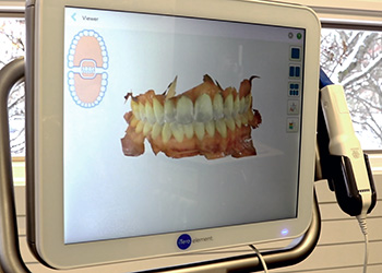 iTero® Intraoral Scanner Orthodontists in Grand Rapids, MI